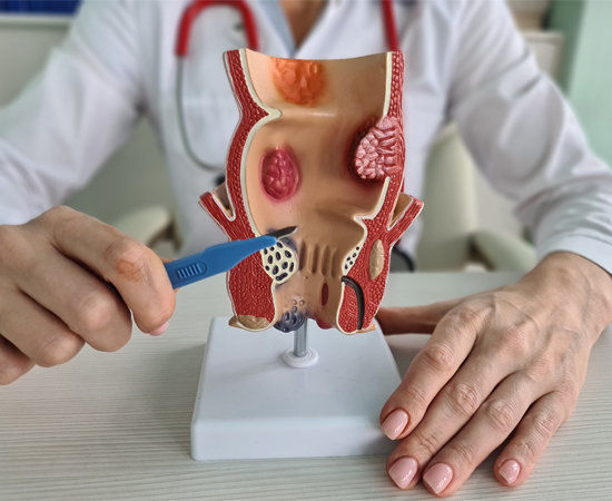 Hemorrhoid Treatment